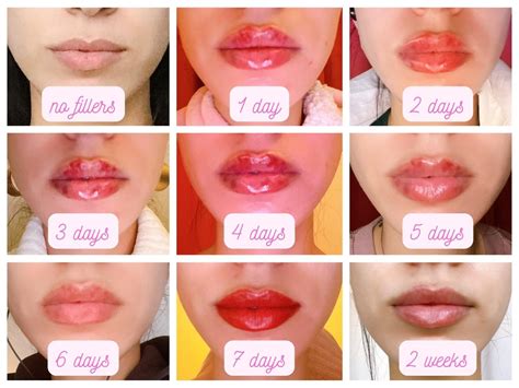 Follow-up post - 0,5ml lip fillers day-by-day before/after : r/PlasticSurgery