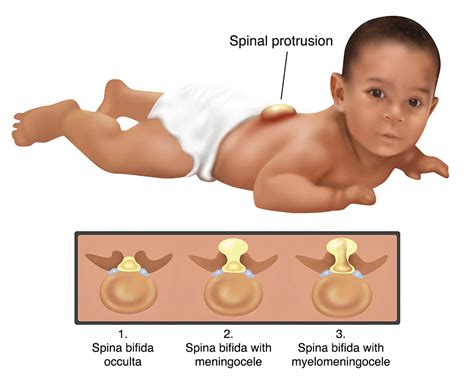 Spina bifida - Cause, Symptoms, Treatment | Mobile Physio.