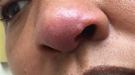 37-Year-Old Female with Rash on Tip of Nose - The Doctor's Channel - Short Videos for Doctors