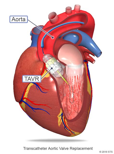 Aortic Valve Disease | The Patient Guide to Heart, Lung, and Esophageal ...