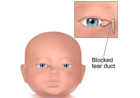 Clogged Lacrimal Duct