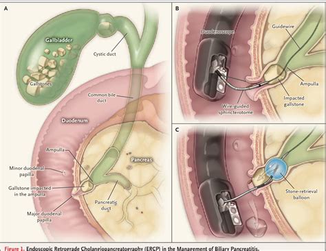 Table 1 from ERCP for gallstone pancreatitis. | Semantic Scholar