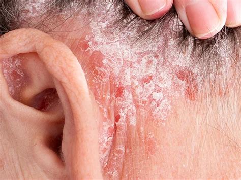 Rash behind ear: Causes, other symptoms, and treatment (2022)