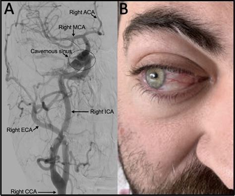 Cureus | Carotid-Cavernous Sinus Fistula Masquerading as Thyroid Eye Disease