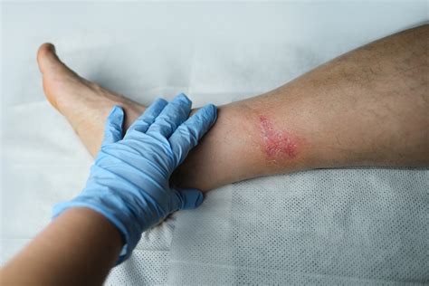 How to tell if a wound is healing or infected | OSF HealthCare