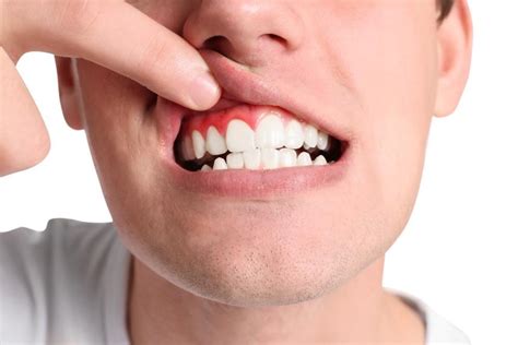 Top Causes of Gum Recession: Tompkins Dental: General Dentistry