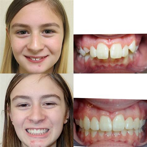 Before And After Braces Overbite