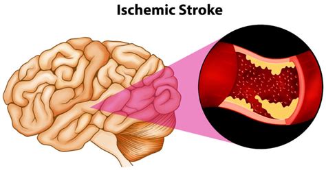 Stroke - First Aid Wiki