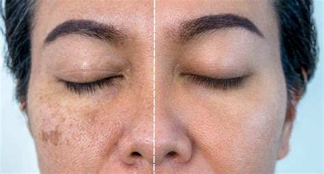 #1 Best Melasma Treatment in Lahore | Rated ⭐⭐⭐⭐⭐ | SKINFUDGE