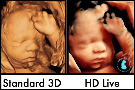 What is 5D Ultrasound? - WonderTime