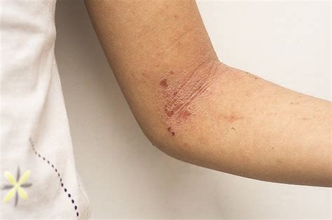 Dermatitis Atopik - Gejala, Penyebab, dan Pengobatan - Alodokter