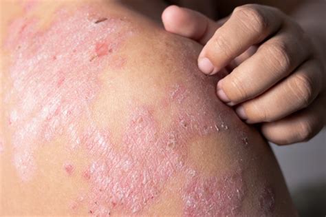 Eczema: causas e sintomas | Emergência ao vivo