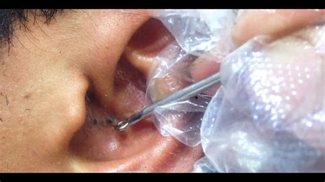 Blackheads in ear | ear blackheads removal | blackheads 2020 - YouTube