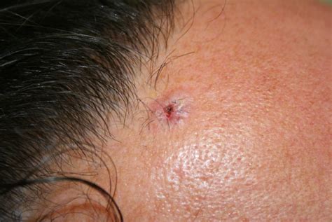 Basal Cell Carcinoma Forehead