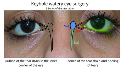 Before and After - Watery Eyes