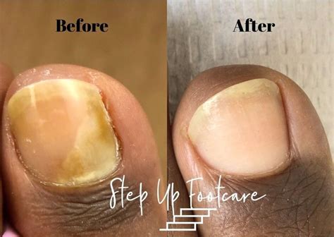 Laser Toenail Fungus Treatment | Podiatrist NYC Downtown | Step Up Footcare