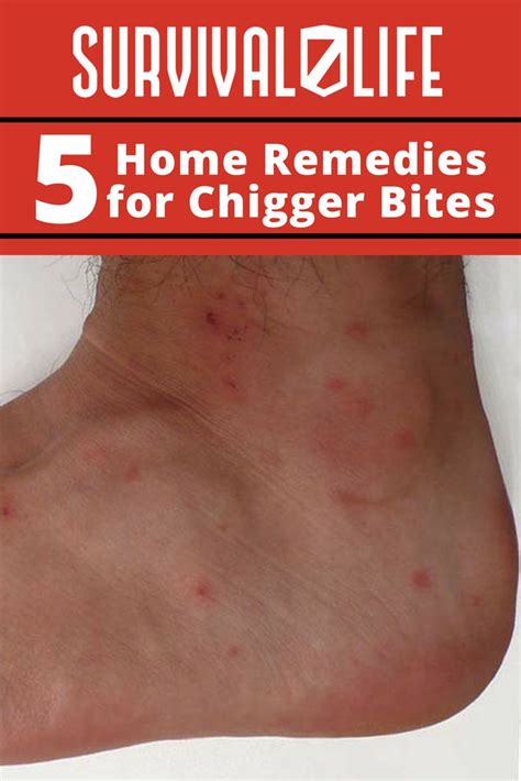 Check out 5 Home Remedies for Chigger Bites at https://survivallife.com/5-home-remedies-for ...