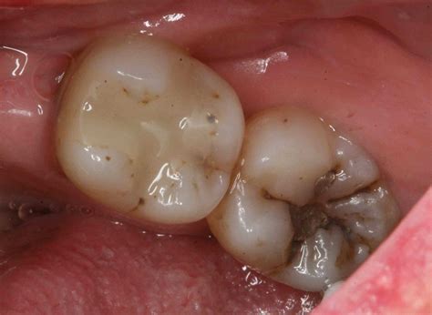 After This, You'll Never Go To The Dentist Again! | TheHealthology | Heal cavities, Oil pulling ...