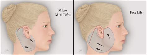 Micro-Mini Lift®: Shorter Recovery Time Than a Facelift