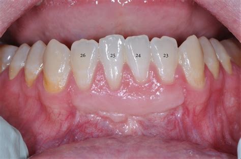 Gingival Graft - Case 1 — Puget Sound Periodontics | Thomas Kang DDS