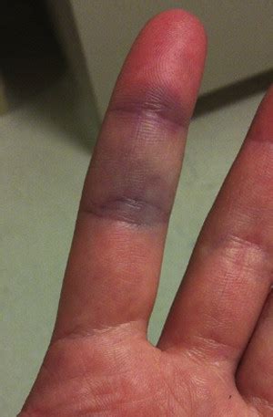 References in Acute Idiopathic Blue Finger: Case Report - Journal of ...