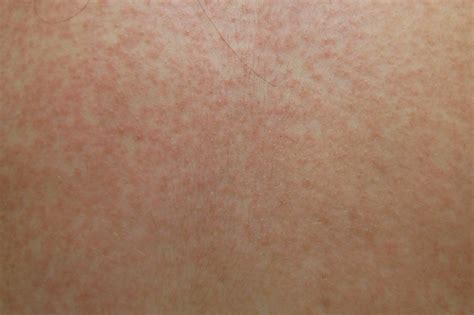 Mild Maculopapular Rash