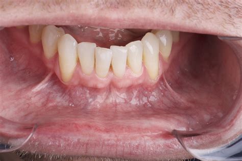 král Lear rohož Diktovat oral cancer on gums Táto Oblázek útes