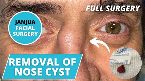 SURGICAL REMOVAL OF LARGE CYST ON NOSE - DR. TANVEER JANJUA - NEW ...