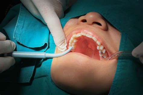 What To Know About Composite Dental Fillings - Villacis Dental ...