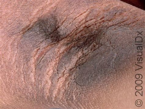 Acanthosis Nigricans Armpit Treatment