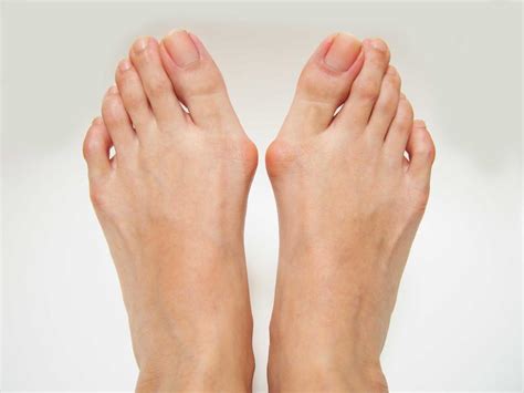 Common Causes of Bunions: North Central Texas Foot & Ankle: Board Certified Podiatrists