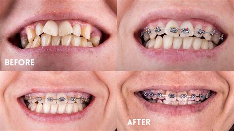 Metal Braces: Pros, Cons and Alternatives