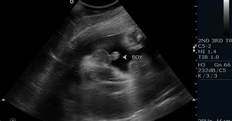 Boy Seen On Ultrasound!