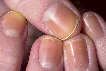 YELLOW FINGERNAILS - Causes, remedies & yellow nail syndrome!