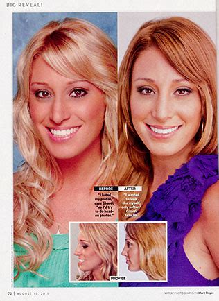 Bachelor Winner Vienna's Nose Job by Dr. Franklin Rose in US Magazine