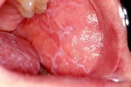 Oral Lichen Planus