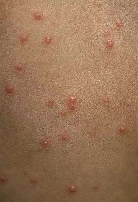 Chicken pox symptoms to look out for from itchy spots and rash to flu ...