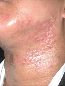 Eczema Acne Serious Relief, Itchy, Scaly Skin, Rashes, Cyst And – ASA ...