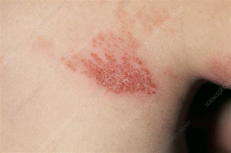 Shingles Rash On Side