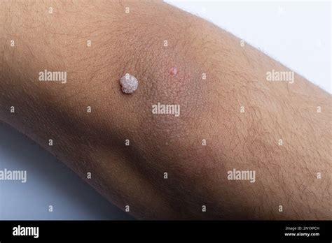 Teenage Boy with Wart on Arm: Causes, Treatment, and Prevention Stock ...