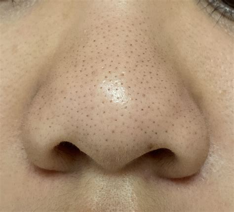 [SKIN CONCERN] How do I minimize the appearance of sebaceous filaments/blackheads on my nose ...