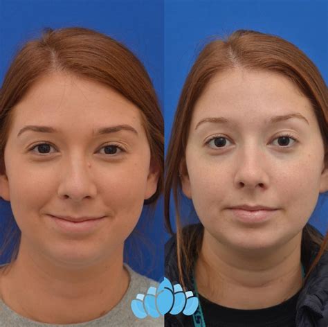 Scar Revision & Mole Removal Before and After Pictures Case 24 | Charlotte, NC | Dilworth Facial ...