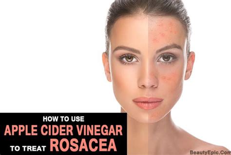 How To Use Apple Cider Vinegar For Rosacea? - Ostomy Lifestyle