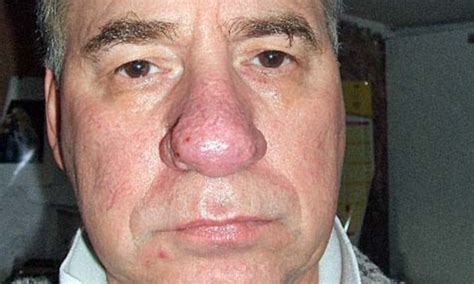 How salt-blasting surgery cured my disfiguring condition called 'drinker's red nose' | Daily ...