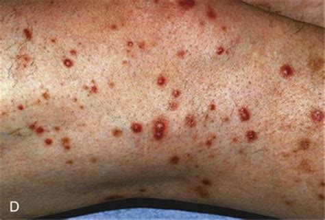 What Stage Of Kidney Disease Causes A Skin Rash Flash - vrogue.co