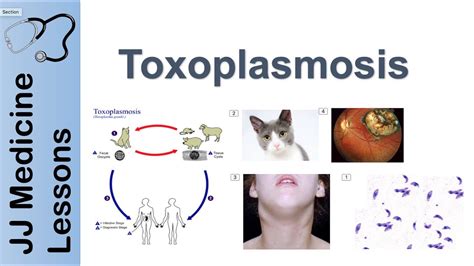 Toxoplasmosis | Acquired vs Congenital | Signs, Symptoms, Diagnosis and Treatment - YouTube