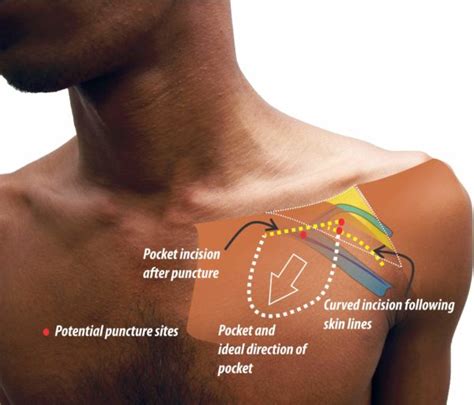 skin cuts schematic – How to Pace