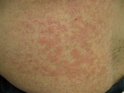 Dust Mite Allergy And Skin Rash Dust Allergy Rash 9 T - vrogue.co
