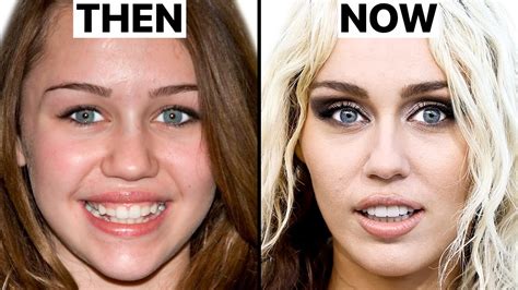 What Happened to Miley Cyrus' Face? | Plastic Surgery Analysis - Oasis ...