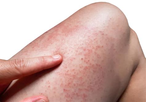 Skin Rashes Allergies
